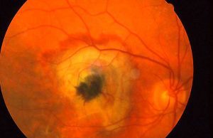 Maculopatia, consumatori sulla scarsa reperibilità di Avastin Maculopatia, consumatori sulla scarsa reperibilità di Avastin