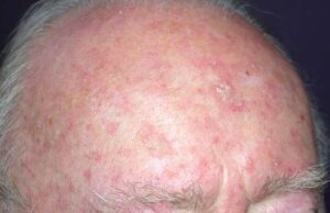 Da FederAnziani una campagna di comunicazione sulla cheratosi attinica Da FederAnziani una campagna di comunicazione sulla cheratosi attinica