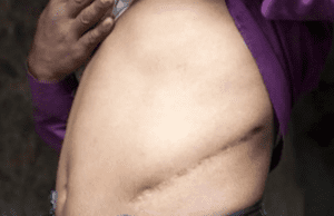 Traffico di organi, ucraina 35enne arrestata: 56 reni venduti sul mercato nero