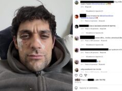 Bresh ferito al volto ironizza: Dobermann 1 – Andrea 0 Bresh ferito al volto ironizza: Dobermann 1 - Andrea 0