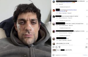 Bresh ferito al volto ironizza: Dobermann 1 – Andrea 0 Bresh ferito al volto ironizza: Dobermann 1 - Andrea 0