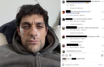 Bresh ferito al volto ironizza: Dobermann 1 – Andrea 0 Bresh ferito al volto ironizza: Dobermann 1 - Andrea 0